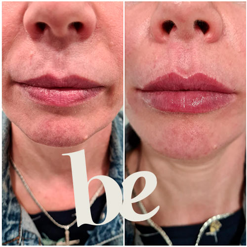 RESULTADO-1 Resultado de Aumento de Labios en Granada