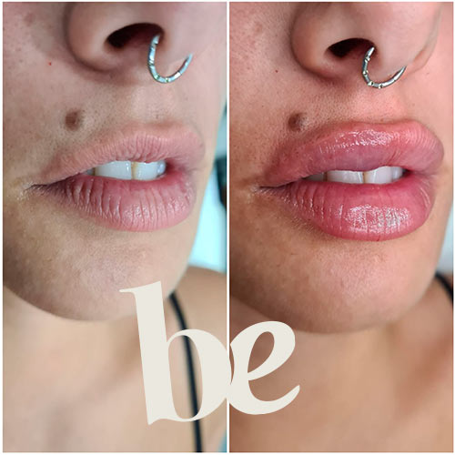 resultado-2 Resultado de Aumento de Labios en Granada