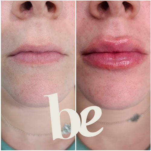 resultado-3 Resultado de Aumento de Labios en Granada