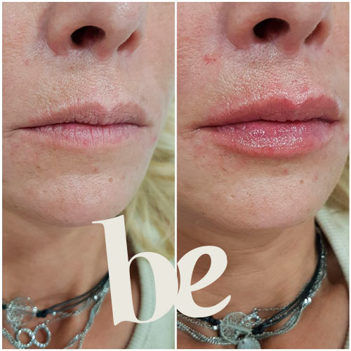 resultado-4 Resultado de Aumento de Labios en Granada