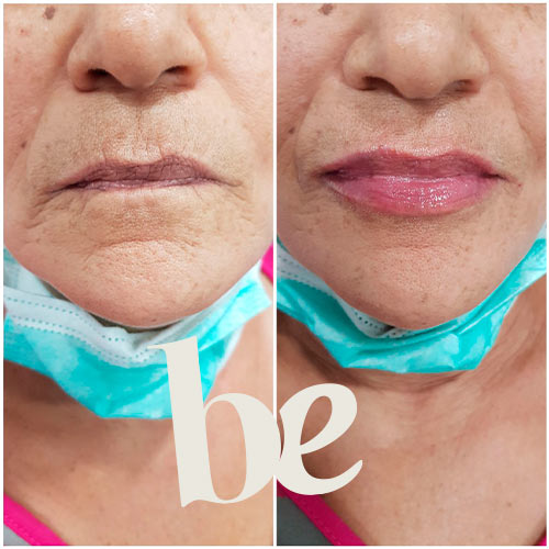 resultado-5 Resultado de Aumento de Labios en Granada