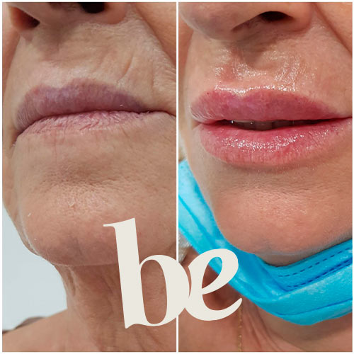 resultado-6 Resultado de Aumento de Labios en Granada