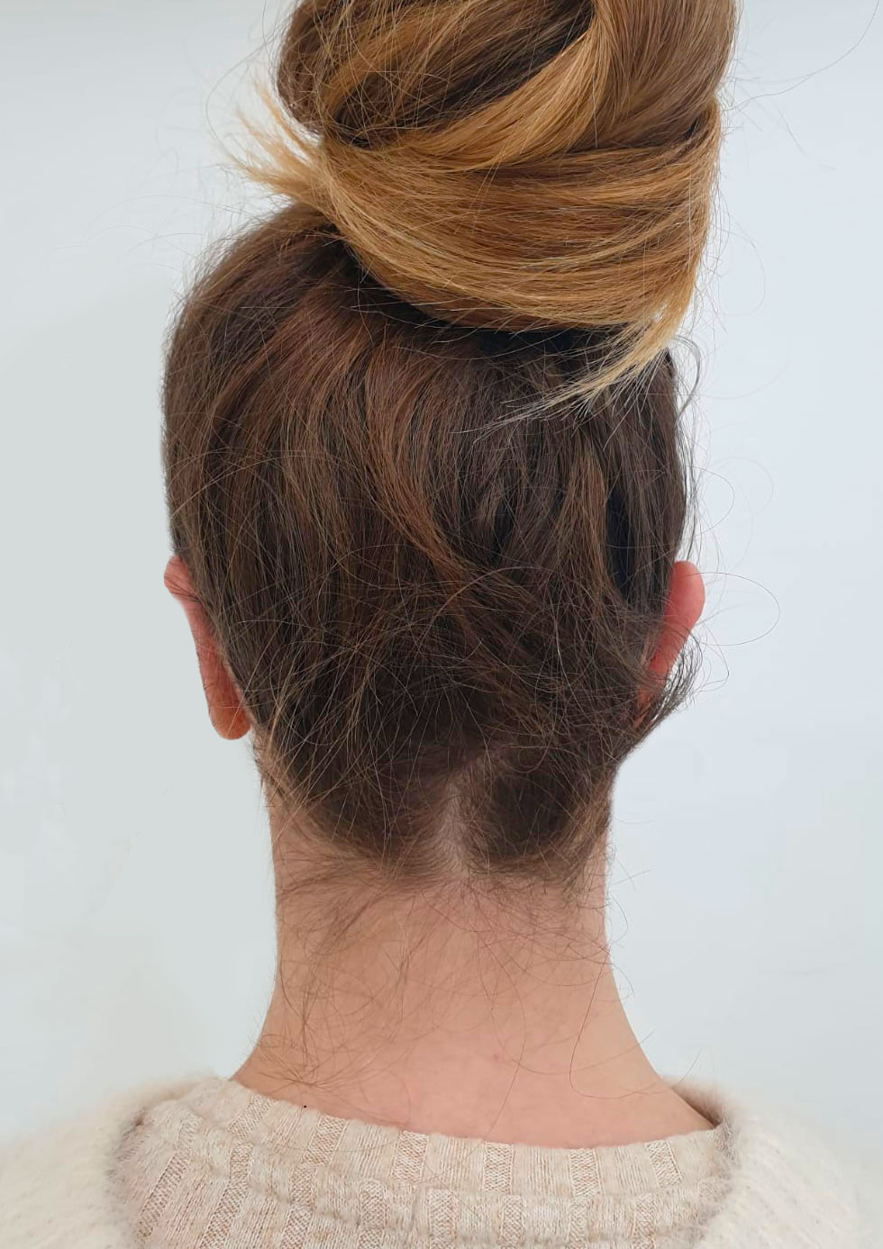 otoplastia-despues-be