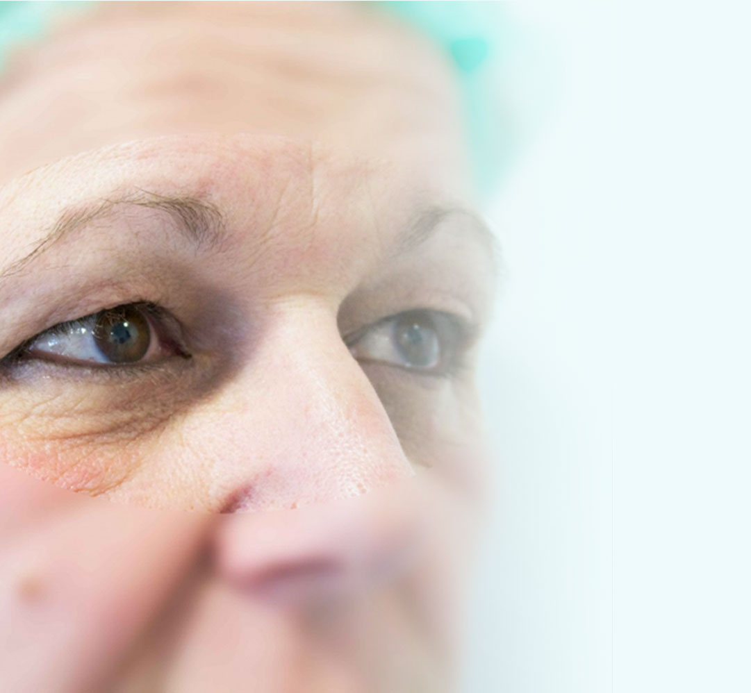 postoperatorio-blefaro