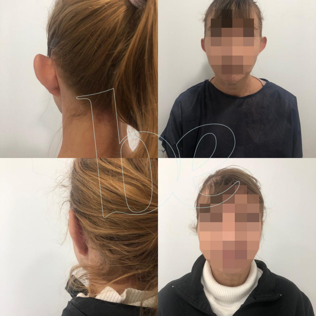 otoplastia-be1