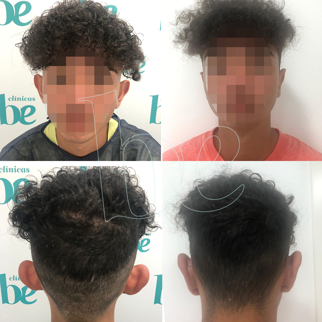 otoplastia-be6